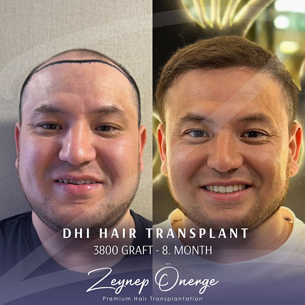 DHI Hair Transplant - Zeynep Önerge - Premium Hair Transplant
